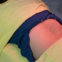 不妊治療　腰部の鍼